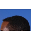 After Hair Transplant&nbsp;Front